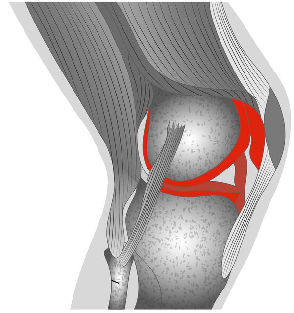 Hinge joint (knee)